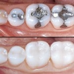 replacing amalgam fillings Brisbane